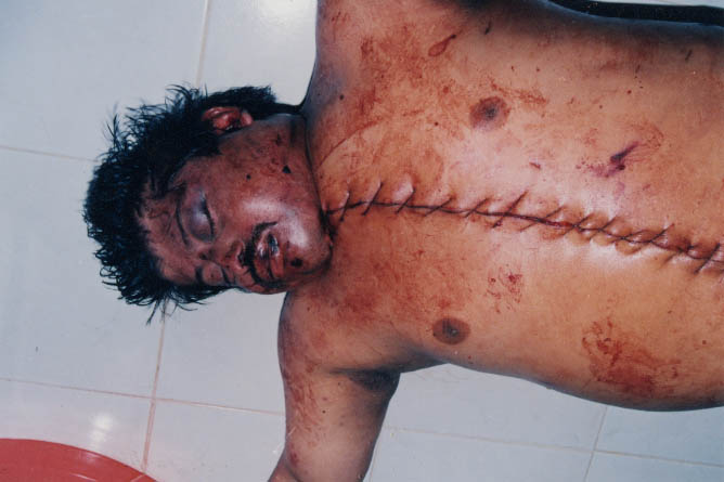 Jose Santos’ body. The sutures down his chest are from the autopsy. Photo by Jorge Muedano